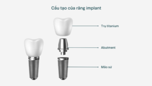 Sơ đồ cấu tạo 3 phần của răng Implant gồm trụ Titanium, Abutment và mão sứ tại DentCare Dental