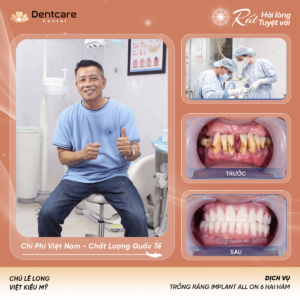 Khách hàng trung niên phục hồi hàm răng mất bằng cấy ghép Implant tại DentCare Dental