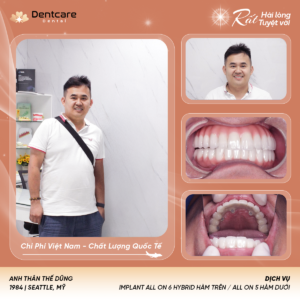 Kết quả thực tế trước và sau khi trồng răng Implant cho khách hàng bị mất răng lâu năm tại DentCare Dental