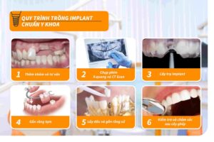 Sơ đồ quy trình 5 bước cấy ghép Implant chuẩn y khoa và vô trùng tuyệt đối tại DentCare Dental