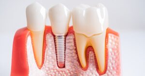 Cận cảnh trụ Implant Titanium nguyên khối chính hãng với thiết kế vòng xoắn tối ưu tại DentCare Dental