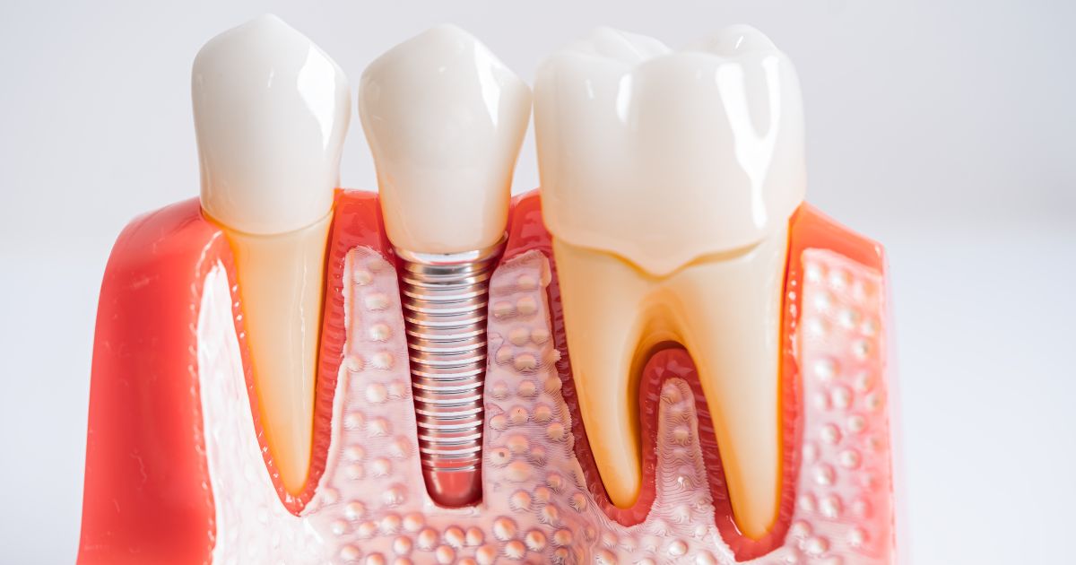 Cận cảnh trụ Implant Titanium nguyên khối chính hãng với thiết kế vòng xoắn tối ưu tại DentCare Dental