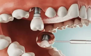 Mô phỏng vị trí trụ Implant tích hợp trong xương hàm và mão răng sứ thẩm mỹ sau khi phục hình tại DentCare Dental